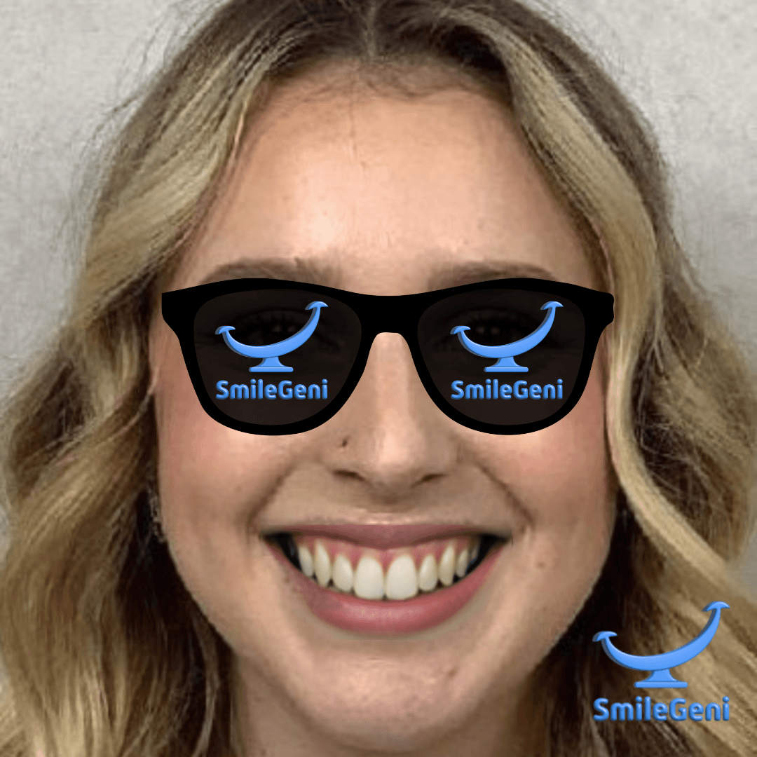 Case 1 — After SmileGeni 2D