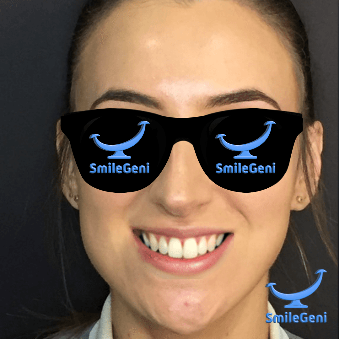 Case 12 — After SmileGeni 2D