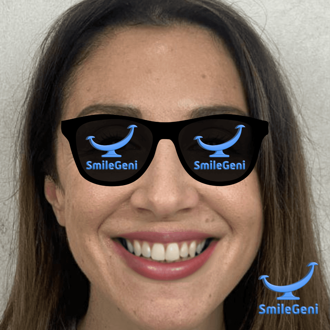 Case 2 — After SmileGeni 2D