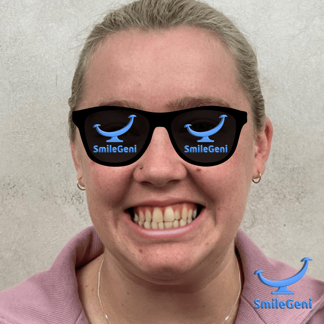 Case 3 — After SmileGeni 2D