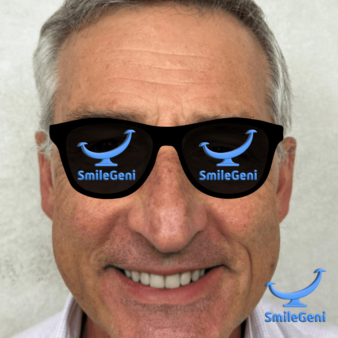 Case 4 — After SmileGeni 2D