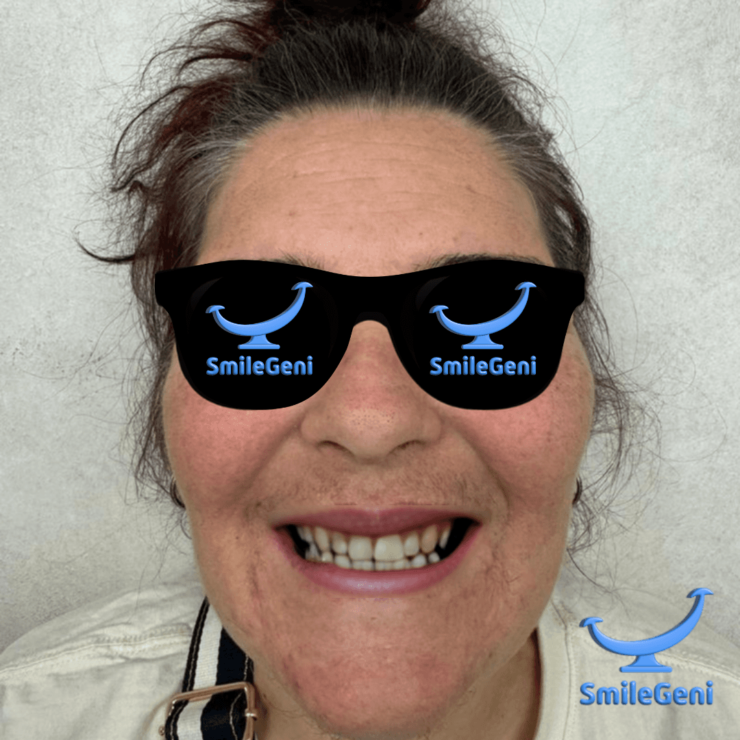 Case 5 — After SmileGeni 2D